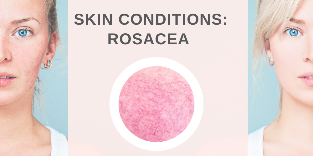 Skin Conditions: Rosacea - Mikel Kristi