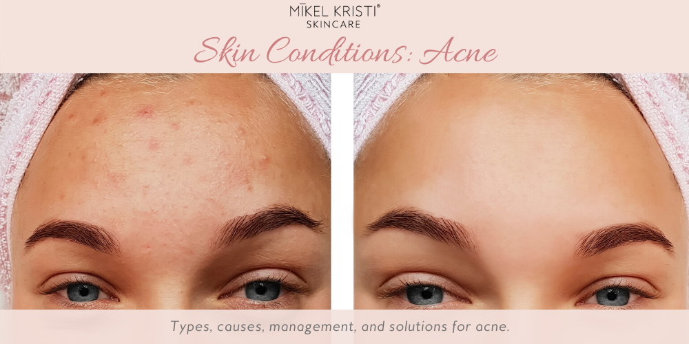 Skin Conditions: Acne blog cover-types, causes, management, and solutions for acne
