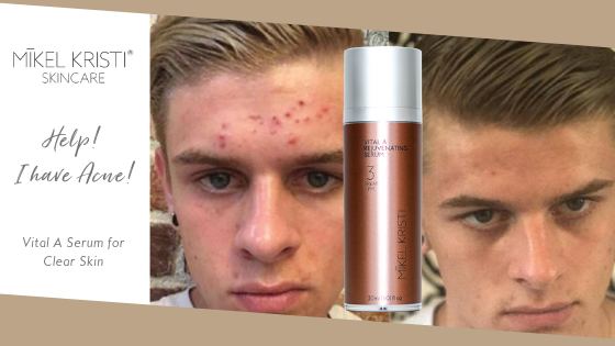 Young man before and after acne pictures