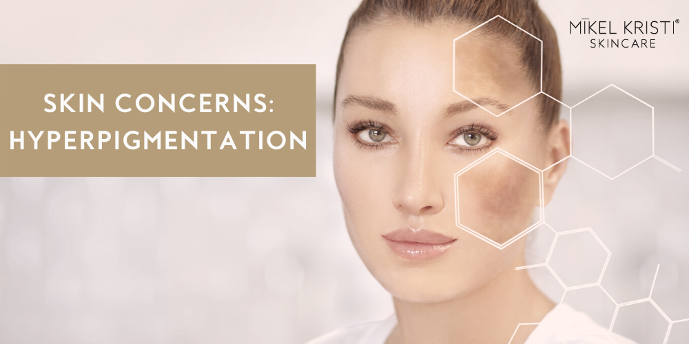 Skin Concerns: Hyperpigmentation - Mikel Kristi